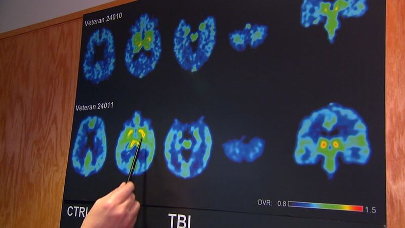 FILE - Brain scans are seen in this file photo. Studies on deceased NFL players' brains found...